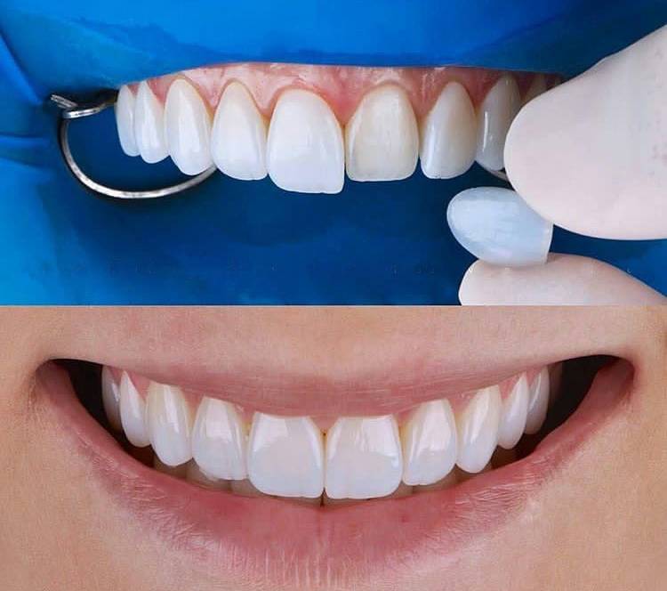 faccette dentali