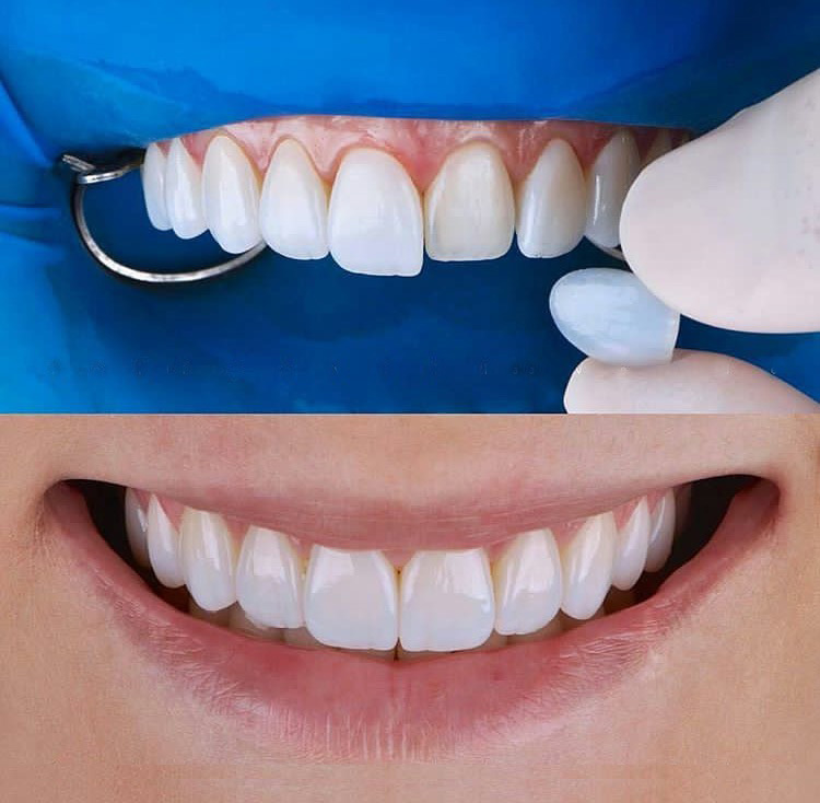 faccette dentali
