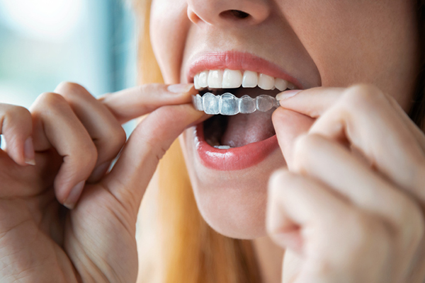 bite dentale